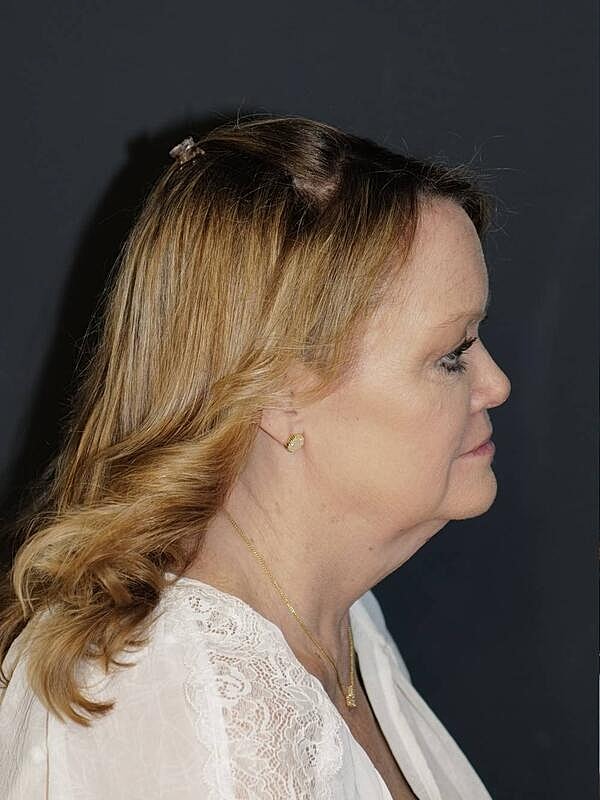 Facelift Neck Lift Before & After