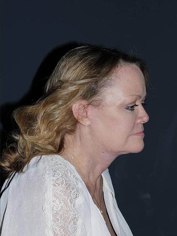 Facelift Neck Lift Before & After
