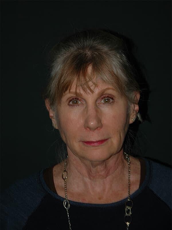 Facelift Neck Lift Before & After