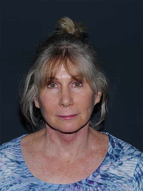 Facelift Neck Lift Before & After