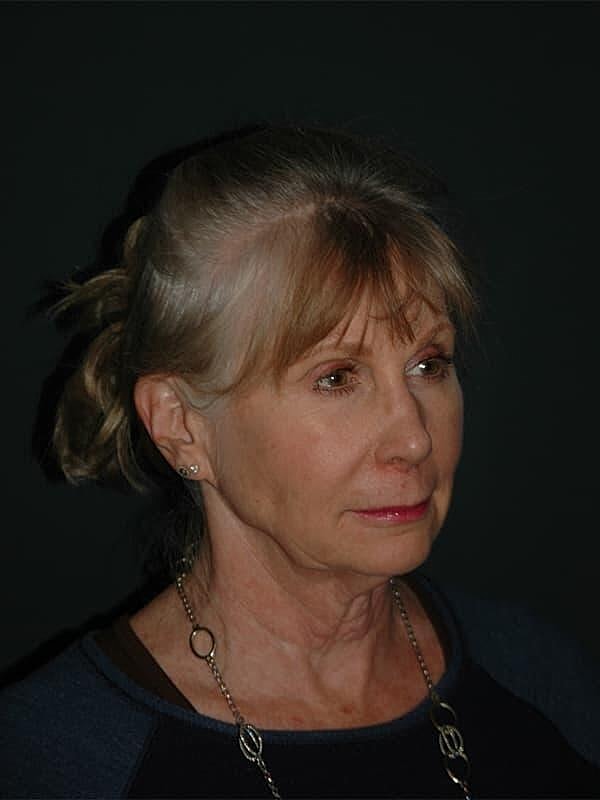 Facelift Neck Lift Before & After