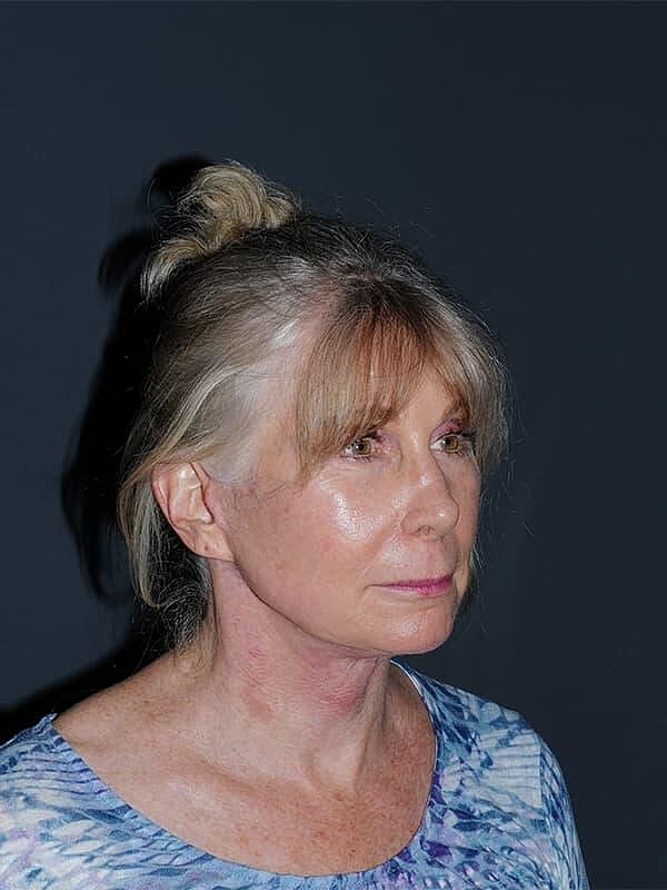 Facelift Neck Lift Before & After