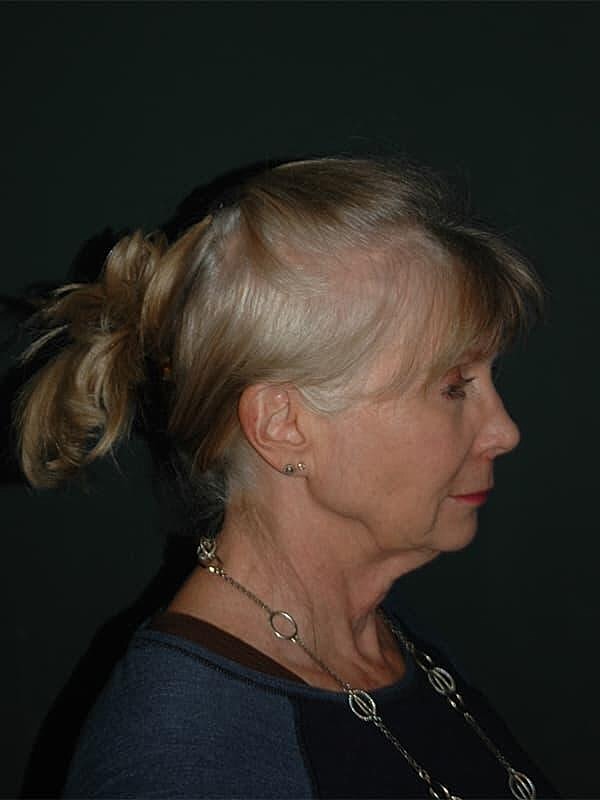Facelift Neck Lift Before & After