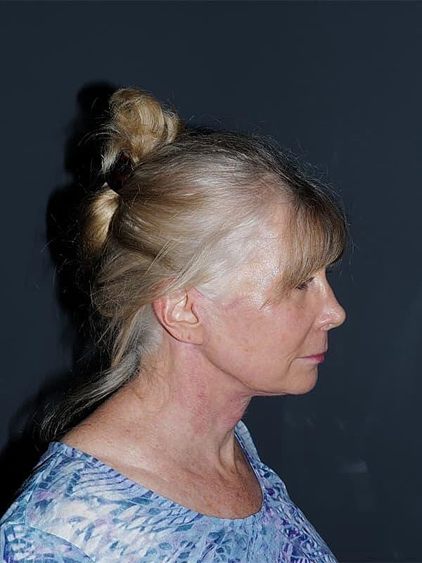 Facelift Neck Lift Before & After