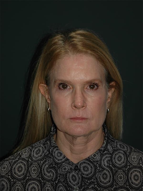Facelift Neck Lift Before & After