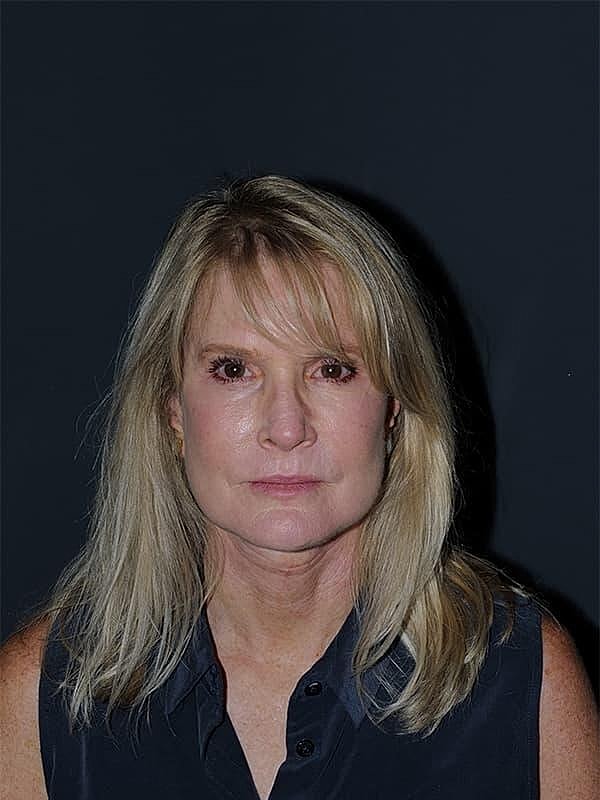 Facelift Neck Lift Before & After