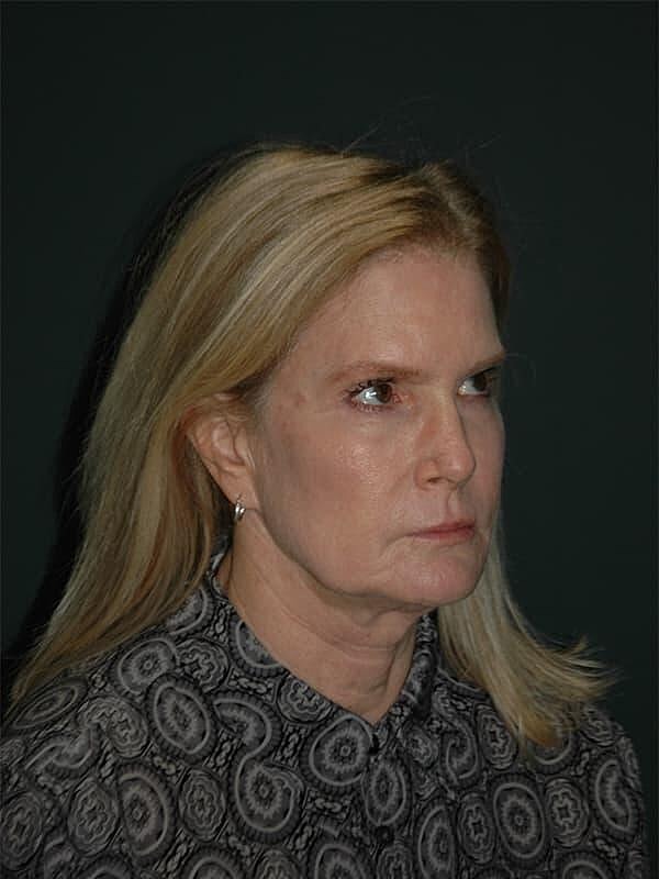 Facelift Neck Lift Before & After
