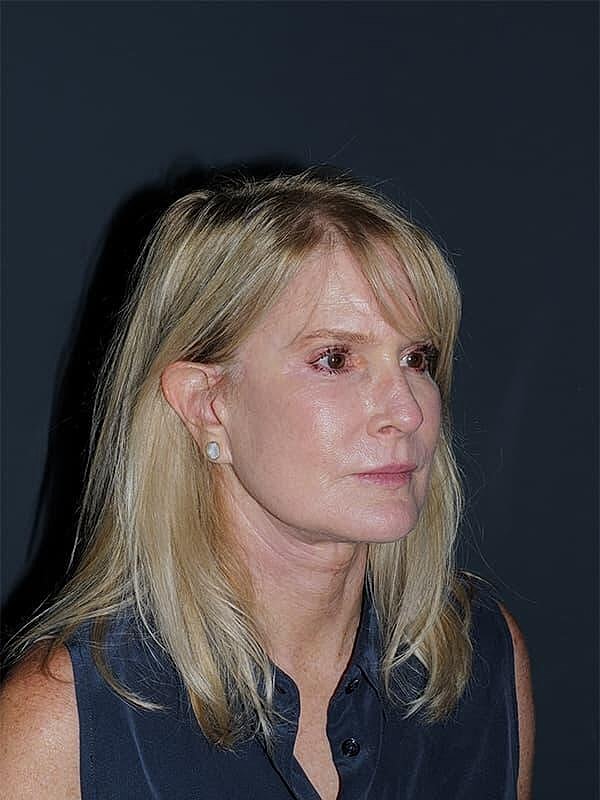 Facelift Neck Lift Before & After