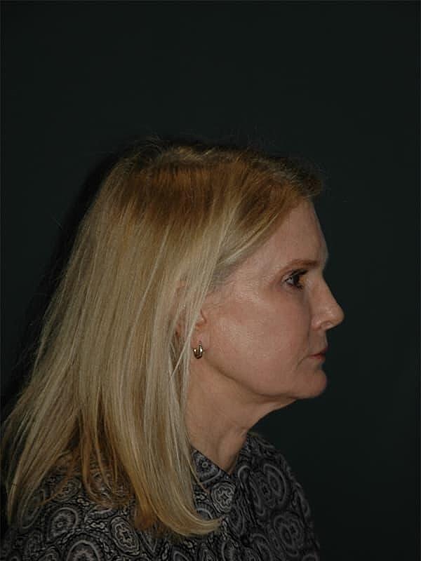 Facelift Neck Lift Before & After
