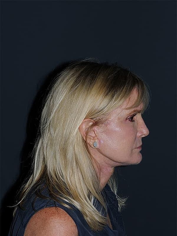Facelift Neck Lift Before & After