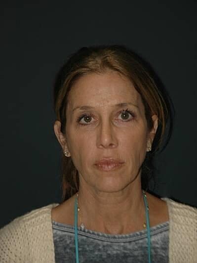 Facelift Neck Lift Before & After