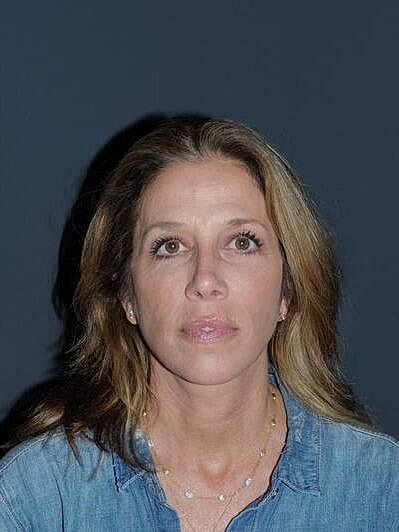 Facelift Neck Lift Before & After
