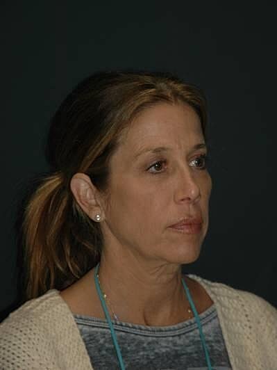 Facelift Neck Lift Before & After