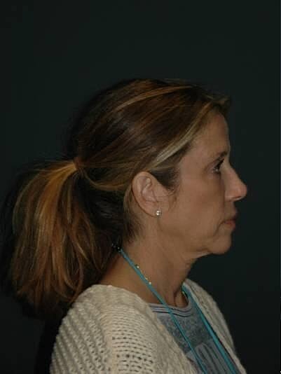 Facelift Neck Lift Before & After