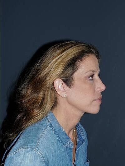 Facelift Neck Lift Before & After