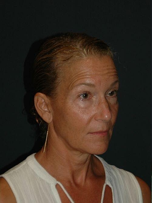 Facelift Neck Lift Before & After