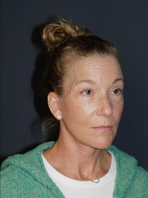 Facelift Neck Lift Before & After