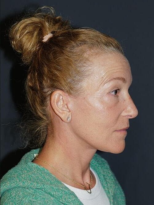 Facelift Neck Lift Before & After