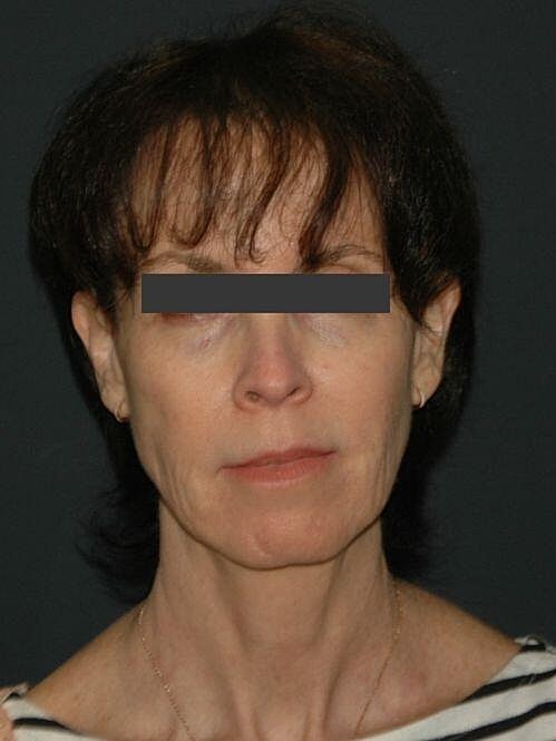 Facelift Neck Lift Before & After