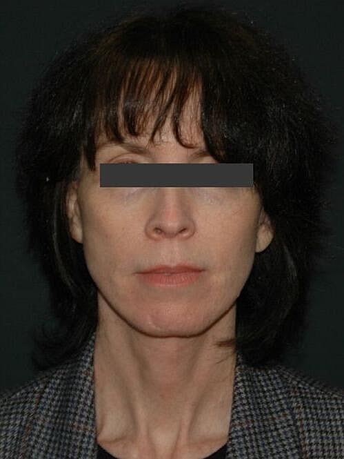 Facelift Neck Lift Before & After
