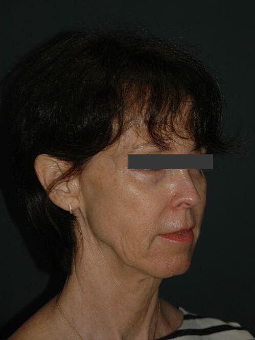 Facelift Neck Lift Before & After