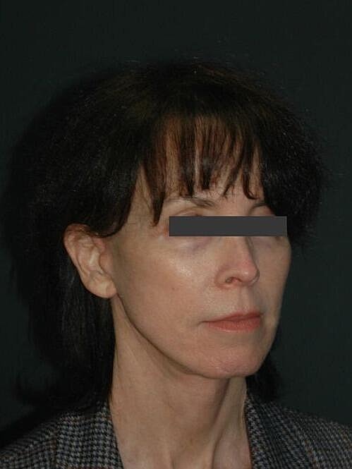 Facelift Neck Lift Before & After
