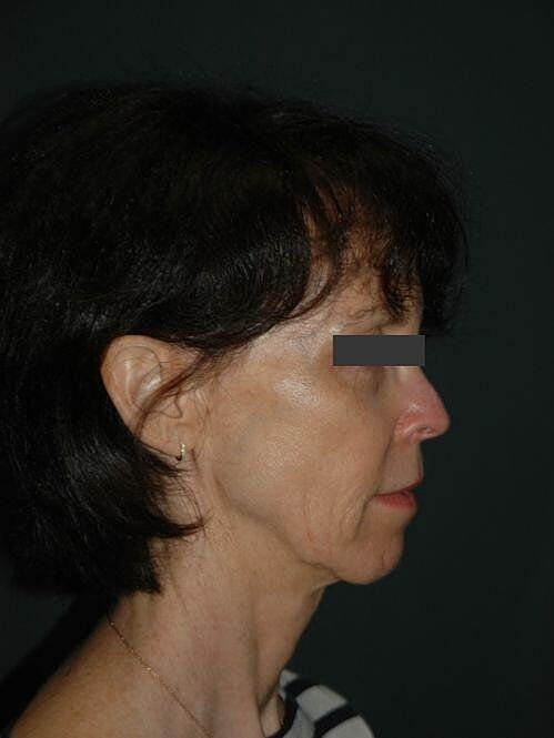 Facelift Neck Lift Before & After