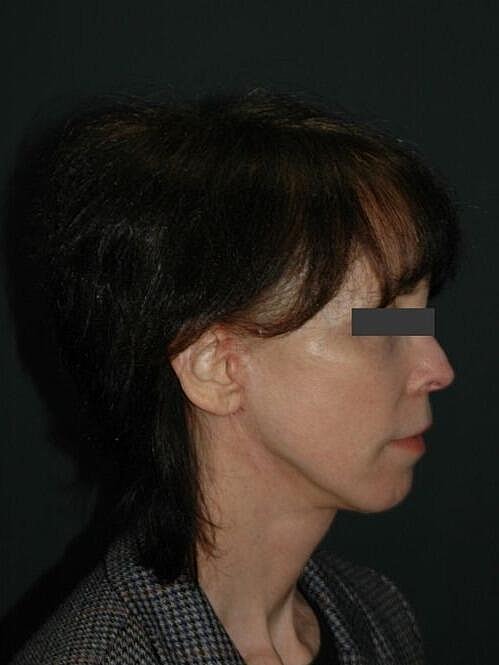 Facelift Neck Lift Before & After