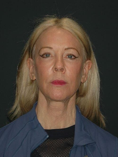 Facelift Neck Lift Before & After
