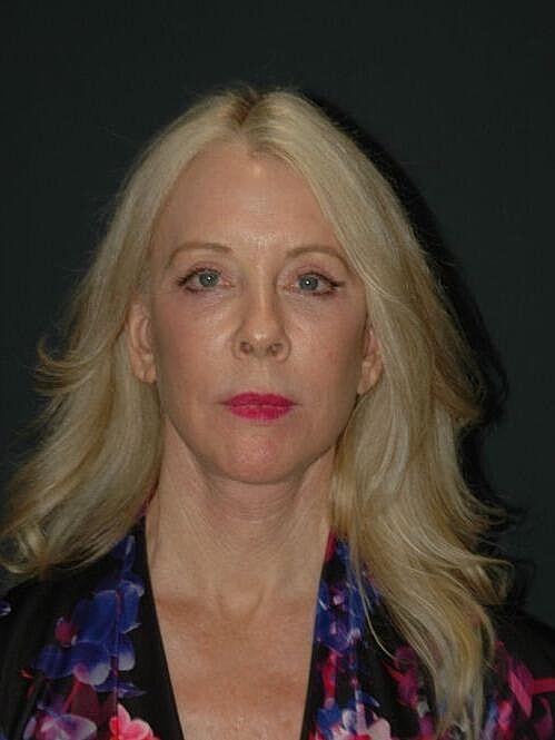 Facelift Neck Lift Before & After
