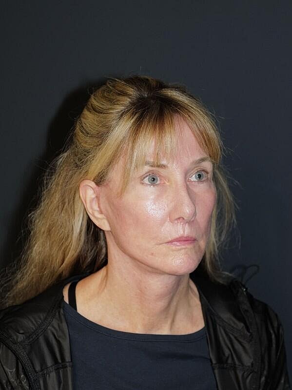 Facelift Neck Lift Before & After
