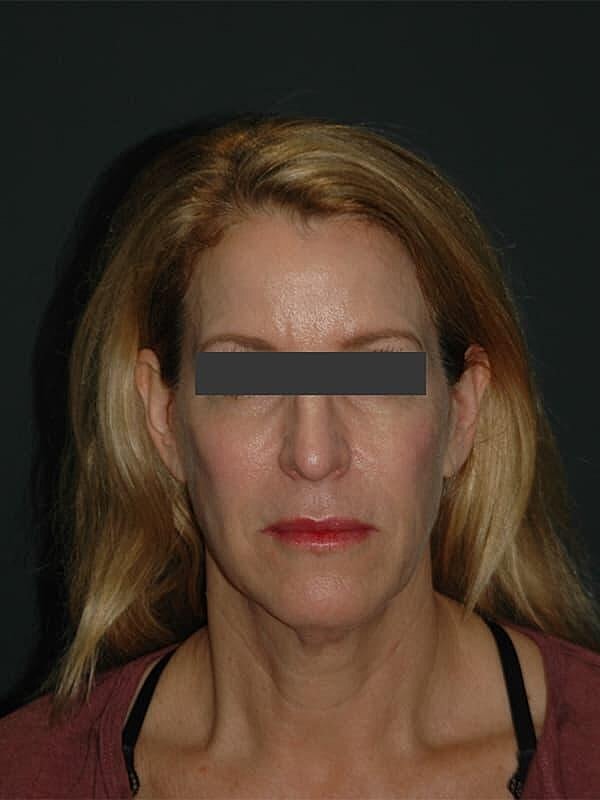 Facelift Neck Lift Before & After