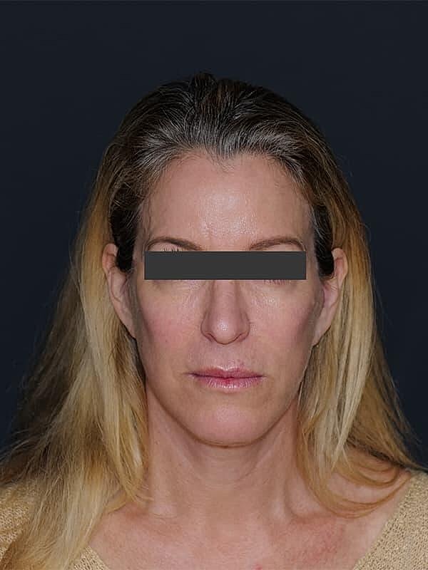 Facelift Neck Lift Before & After