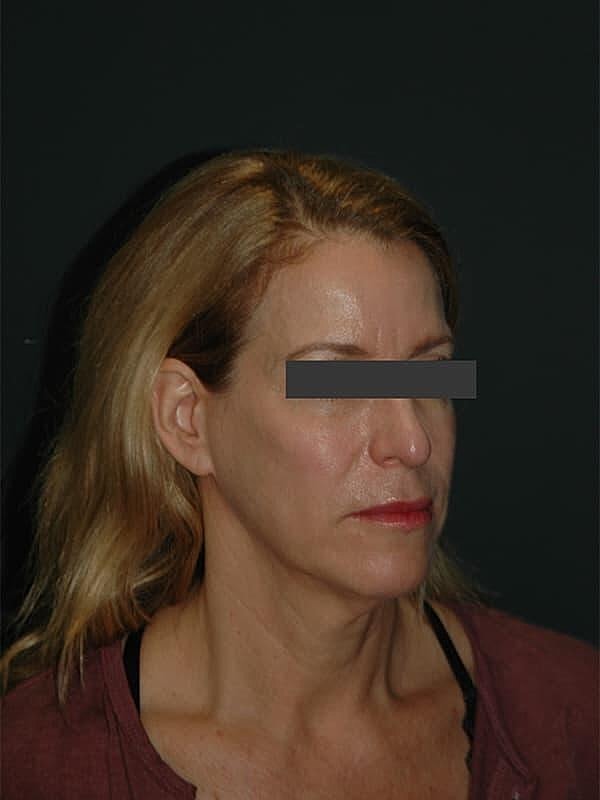 Facelift Neck Lift Before & After