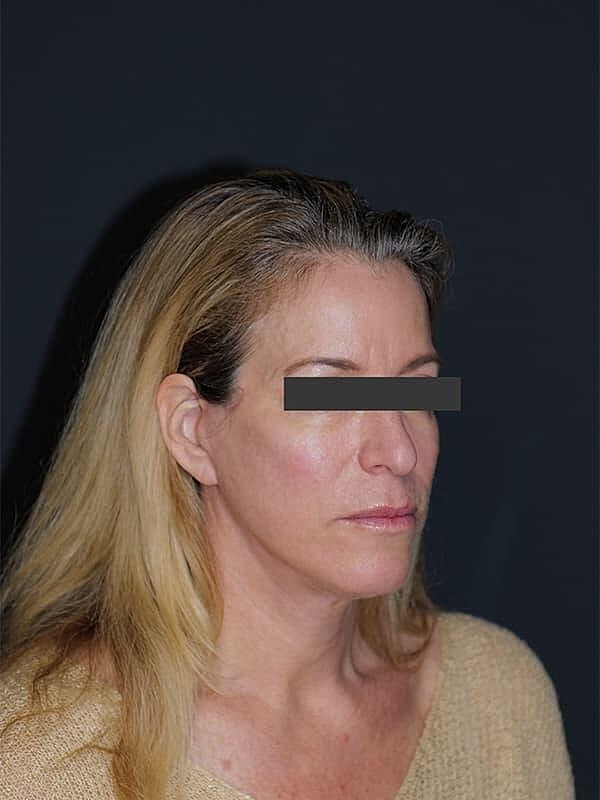 Facelift Neck Lift Before & After