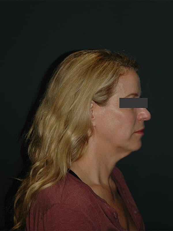 Facelift Neck Lift Before & After