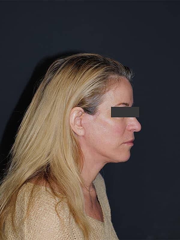 Facelift Neck Lift Before & After