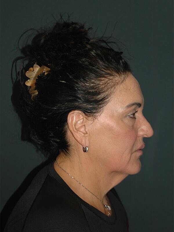 Facelift Neck Lift Before & After