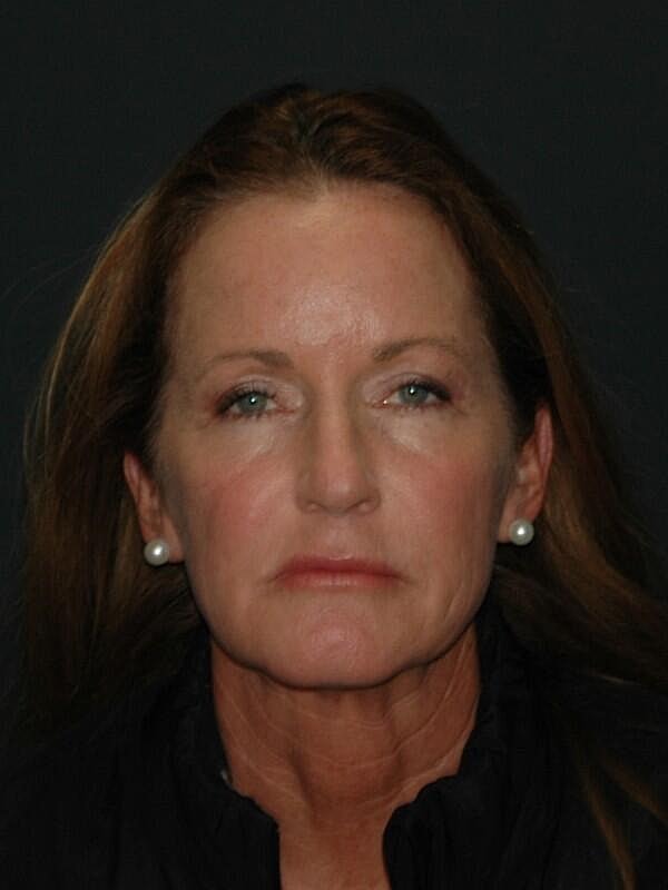 Facelift Neck Lift Before & After