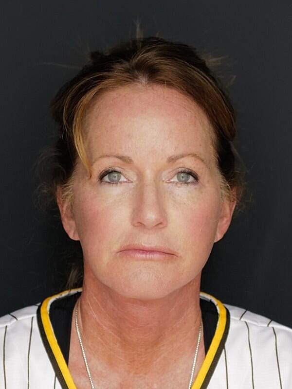 Facelift Neck Lift Before & After