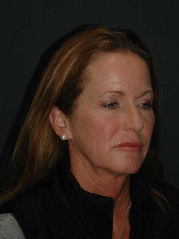 Facelift Neck Lift Before & After