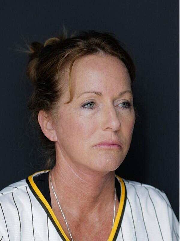 Facelift Neck Lift Before & After