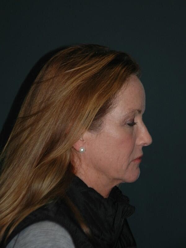 Facelift Neck Lift Before & After