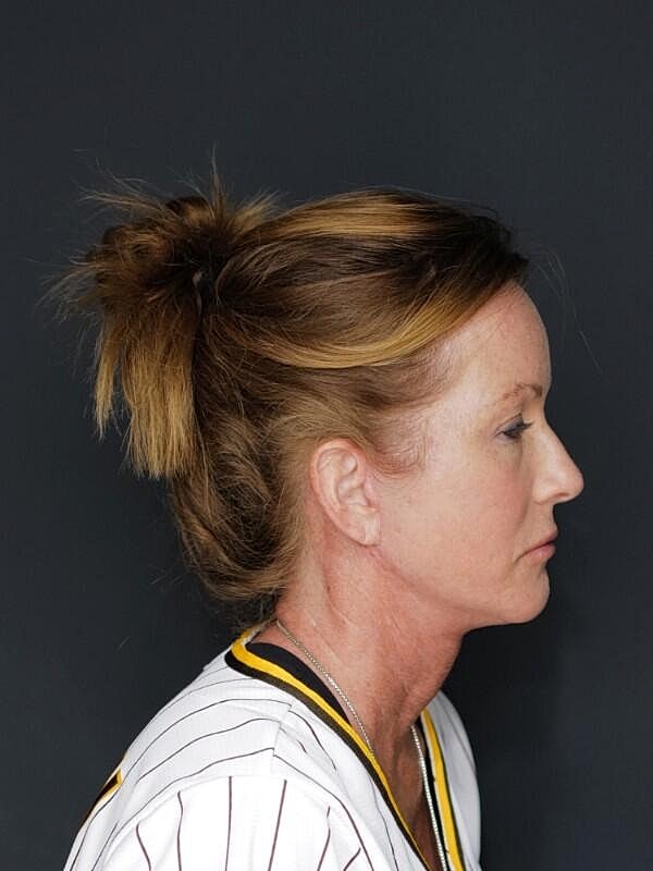 Facelift Neck Lift Before & After