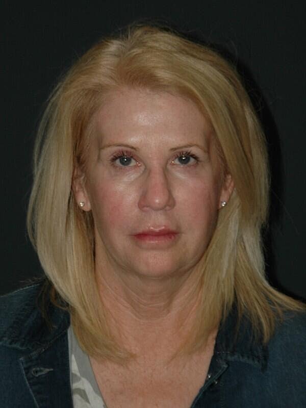 Facelift Neck Lift Before & After