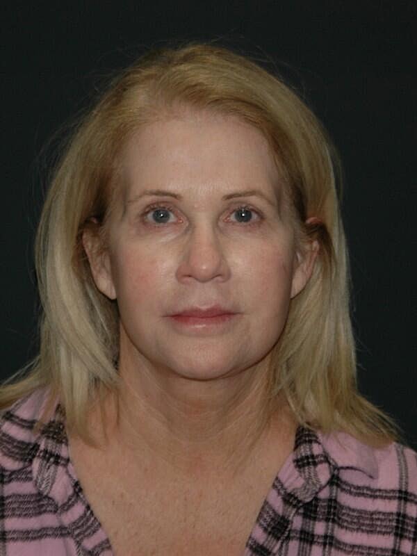 Facelift Neck Lift Before & After