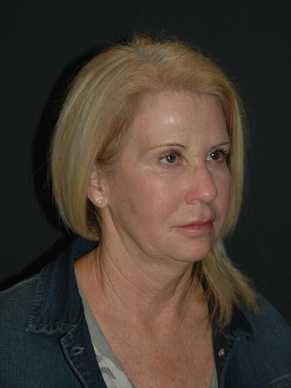Facelift Neck Lift Before & After