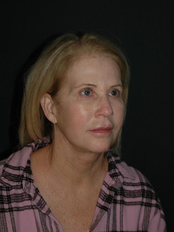 Facelift Neck Lift Before & After