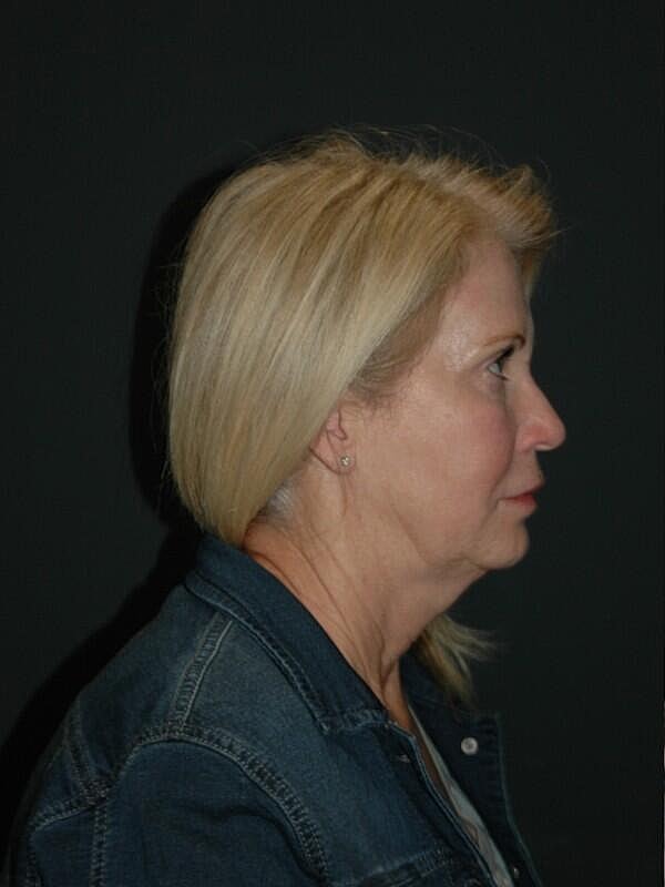 Facelift Neck Lift Before & After