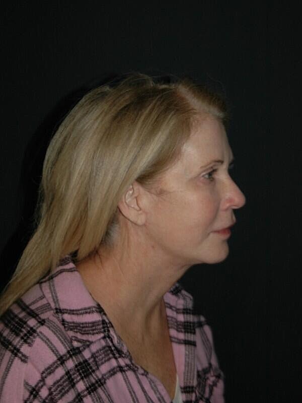 Facelift Neck Lift Before & After